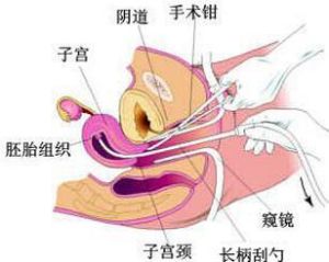 清宮術