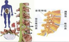 腰椎間盤突出症的手法治療