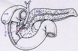 缺血性腸絞痛