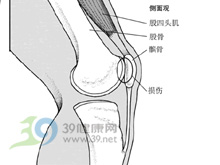 髕股關節疼痛