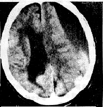 外傷性腦積水