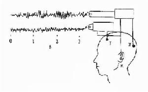（圖）腦電圖三相波