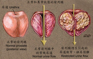 急性細菌性前列腺炎