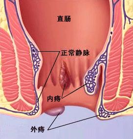 炎性外痔瘡