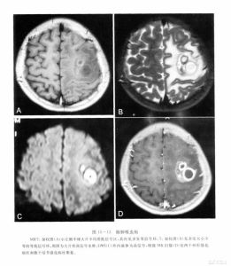 腦肺吸蟲病