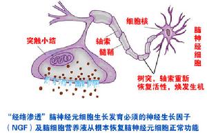 癲癇滲透激活術