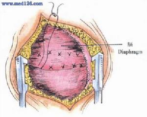 膈肌麻痹