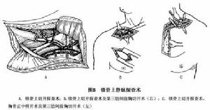 頸部開放性損傷