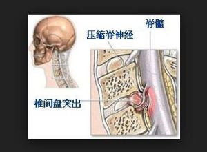 頸椎間盤突出