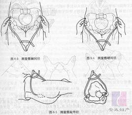 骨盆外測量