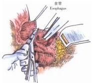 示意圖3:剪開鬆弛的膈食管韌帶