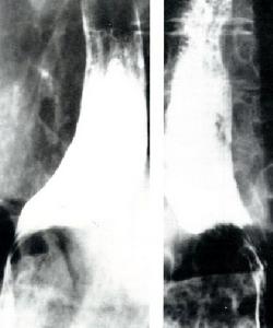 結締組織性腸炎