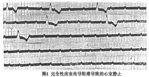 心室靜止