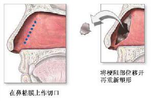 鼻中隔膿腫