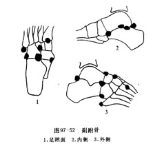 先天性副肌強直症