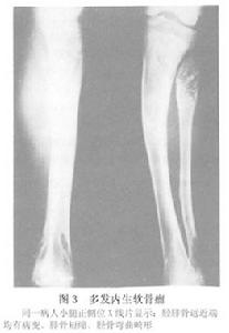 （圖）多發內生軟骨瘤病
