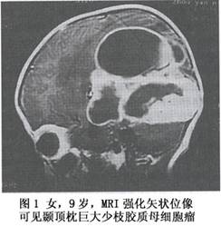 （圖）兒童大腦半球膠質瘤