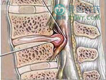 老年人脊髓壓迫症
