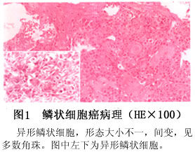 假腺樣鱗狀細胞癌