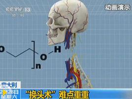 人體換頭術