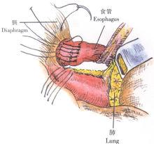 示意圖7:縫合膈食管韌帶游離緣與膈肌裂孔