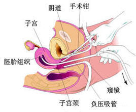 人流手術