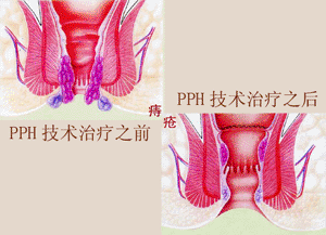 痔瘡微創手術