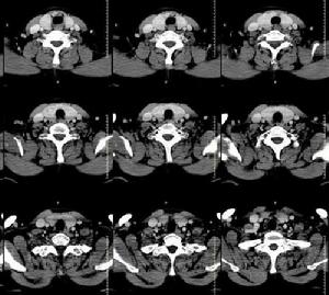 雙側甲狀腺腫大 - CT病例