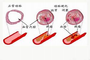 糖尿病腎臟病變