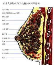 重度乳腺增生