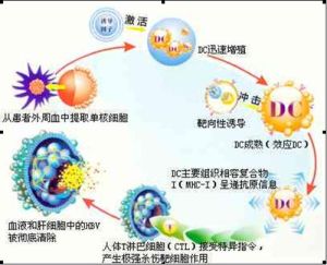 靶向DC-CIK細胞療法