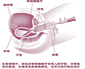 宮腔鏡檢查