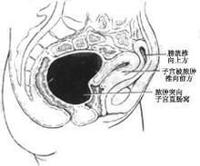 化膿性盆腔血栓靜脈炎