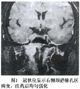 頸靜脈球瘤