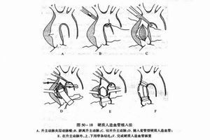 胸主動脈瘤