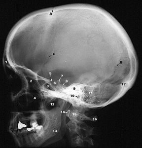 頭顱X線平片