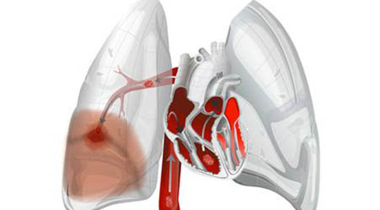 肺栓塞