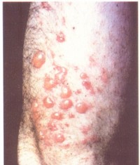 （圖）皰疹樣膿痂疹