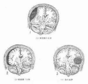 創傷性顱內血腫