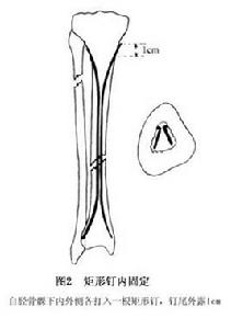（圖）脛腓骨骨幹骨折
