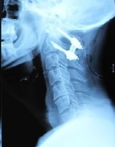 伴齒狀突骨折的寰樞椎前脫位