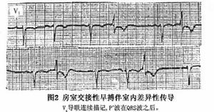 房室交接區性期前收縮