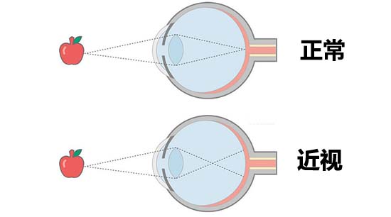 近視示意圖