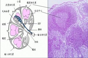 慢性頸淋巴結炎