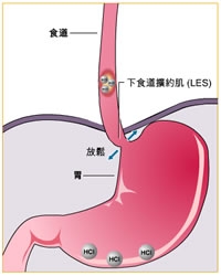 胃泌素瘤