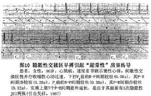 房室交接區性期前收縮