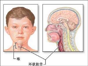 氣管切開術