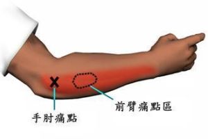 肱骨外上髁炎