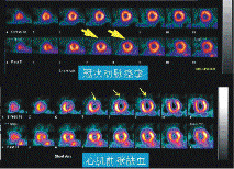 心肌血流灌注顯象