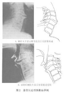 （圖）食管壓迫型頸椎病 圖2